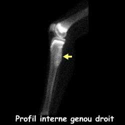 Temps osseux - Genou droit profil interne