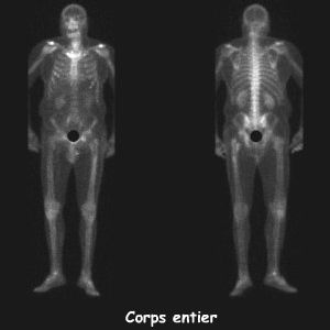 Temps osseux - Corps entier