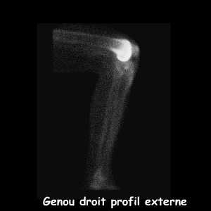 Genou droit - Profil externe