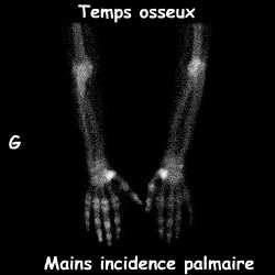 Temps osseux