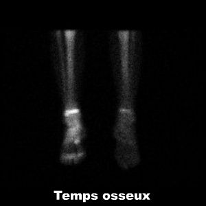 Temps osseux