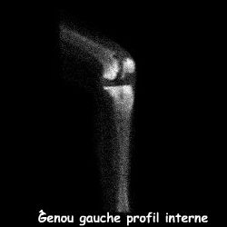 Temps osseux - Profil interne
