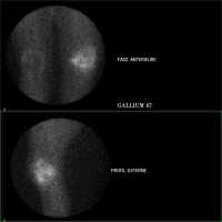 Gallium