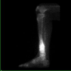 Temps osseux - Profil externe tibia droit