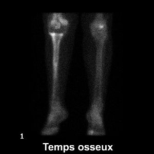 Temps osseux