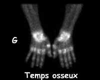 Mains incidence palmaire
