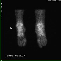Temps osseux