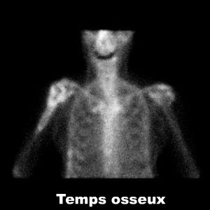Temps osseux