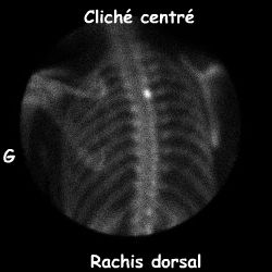 Rachis dorsal - Incidence post&eacute;rieure