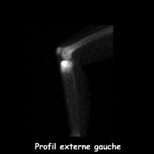 Genou gauche profil externe