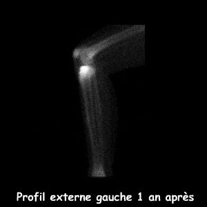 Genou gauche profil externe