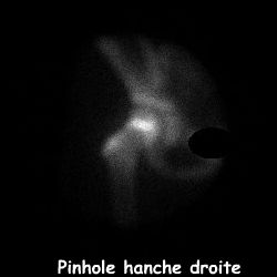 Clich&eacute; pinhole hanche droite