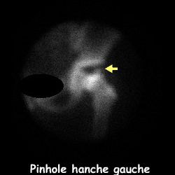Clich&eacute; pinhole hanche gauche