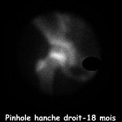 Clich&eacute; pinhole hanche droite - 18 mois