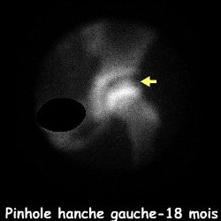 Clich&eacute; pinhole hanche gauche - 18 mois