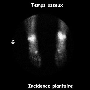 Temps osseux - Pieds vue plantaire