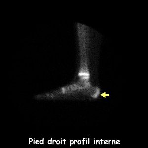 Pied droit - Profil interne