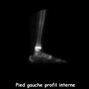 Pied gauche - Profil interne