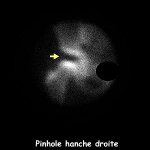 Clich&eacute; pinhole hanche droite
