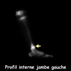 Profil interne - Jambe gauche