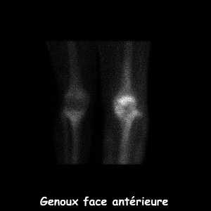 Temps osseux - Genoux face ant&eacute;rieure