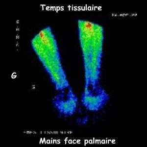 Temps tissulaire - Avant-bras