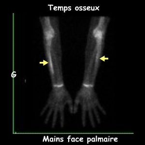 Temps osseux - Avant-bras