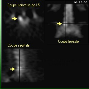 Coupes tomoscintigraphiques