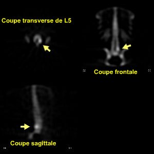 Coupes tomoscintigraphiques