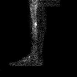 Temps osseux - profil interne tibia droit