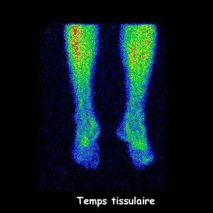 Temps tissulaire - Incidence dorsale