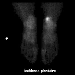 Temps osseux - Incidence plantaire