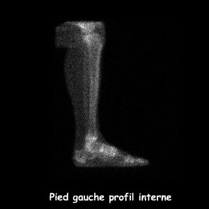 Temps osseux - Profil interne Pied gauche