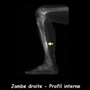Jambe droite - Profil interne