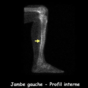 Jambe gauche - Profil interne