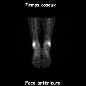 Jambes - Temps osseux