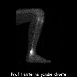 Profil externe jambe droite