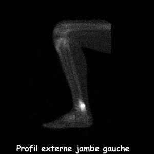 Profil externe jambe gauche