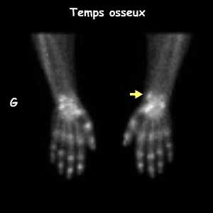 Temps osseux