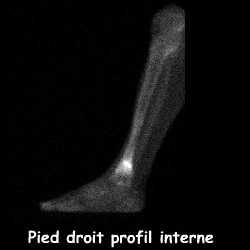 Temps osseux - Pied droit profil interne