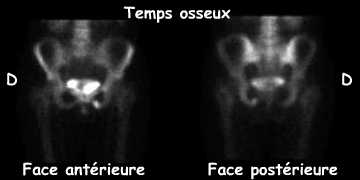 Temps osseux