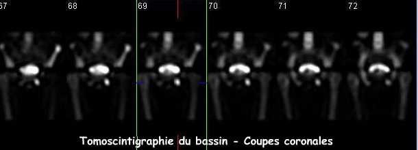 Tomoscintigraphie du bassin