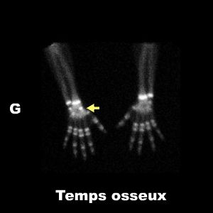 Temps osseux