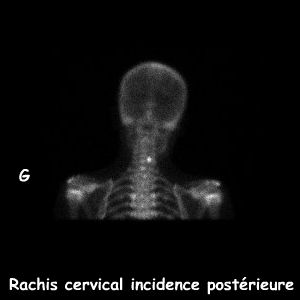 Rachis cervical - Incidence post&eacute;rieure