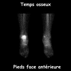 Pieds face ant&eacute;rieure - Temps osseux