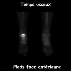 Pieds face ant&eacute;rieure - Temps osseux