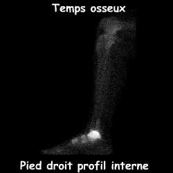 Pied droit - Profil interne