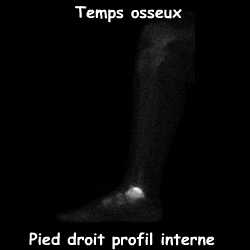 Pied droit - Profil interne