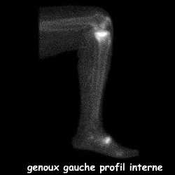Temps osseux - profil interne genou gauche
