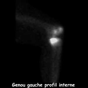 Profil interne genou gauche